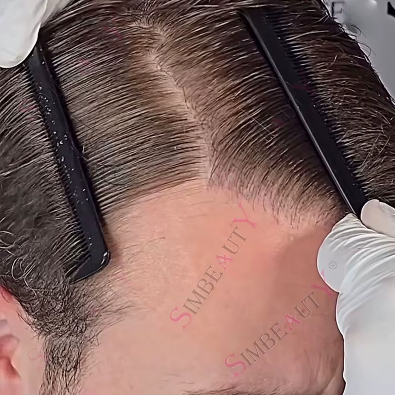 80% densité 0.02mm indétectable peau Ultra mince brun foncé hommes toupet noir gris 1B20 système de 