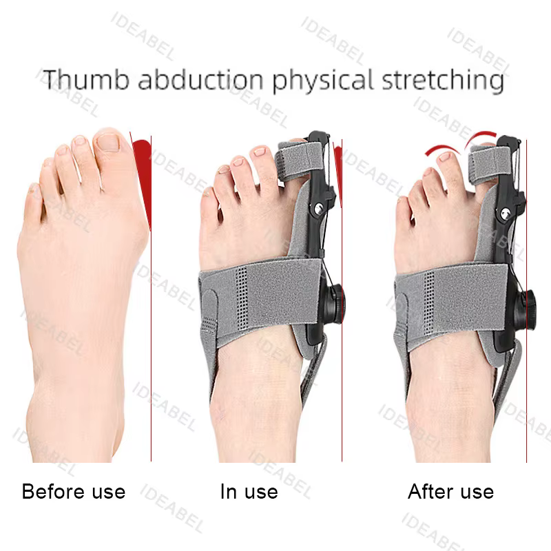 Attelle orthopédique correctrice pour hallux valgus, redresseur d'orteil, soulagement de la douleur au pied, correction du hallux valgus, soins des pieds