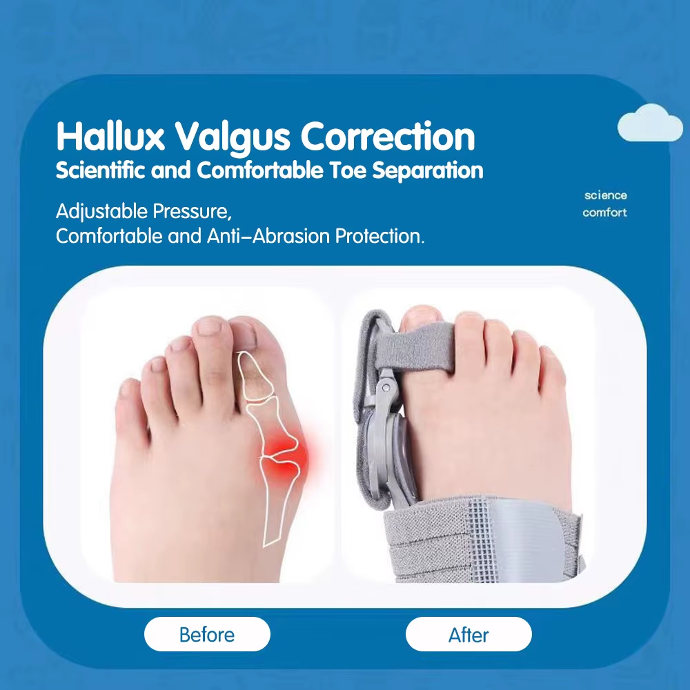 Correcteur d'hallux valgus, redresseur d'orteils, orthèses de correction pour l'arthrose du pied, ajusteur d'orteil, correcteur de pieds pour hallux valgus